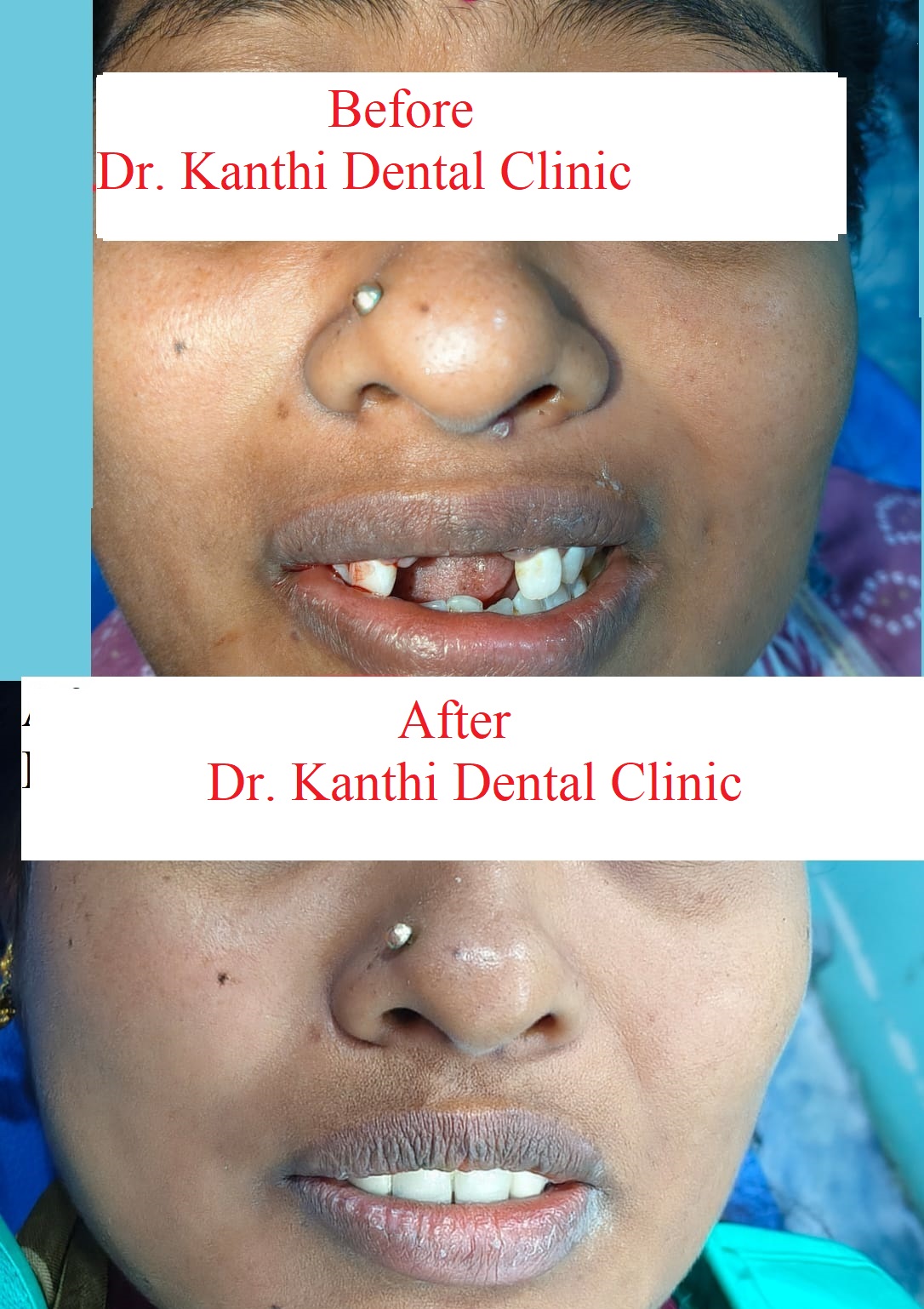 Cosmetic Smile Makeover Portrait Case 2